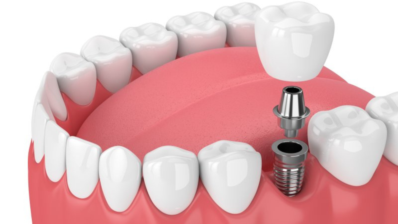 Dental Implants