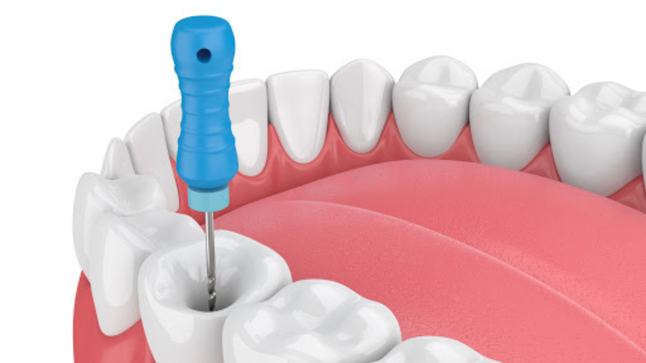 Root Canal