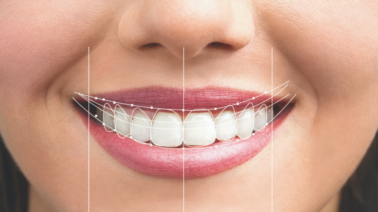 Smile Design