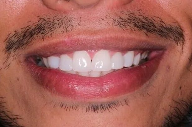 After Treatment - Dental White