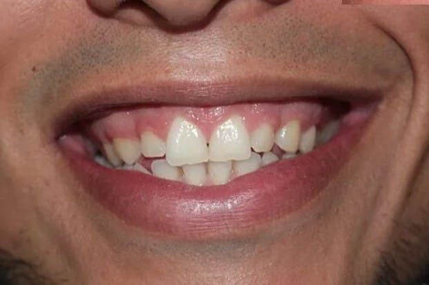 Before Treatment