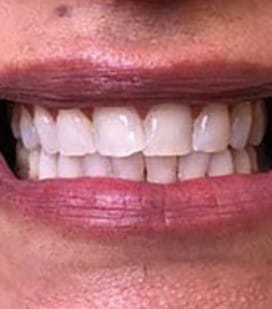 After Treatment - Dental White
