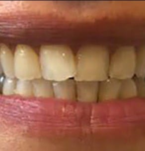 Before Treatment