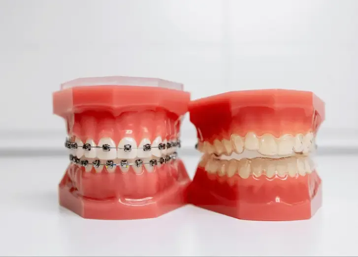 Clear Aligners vs Braces