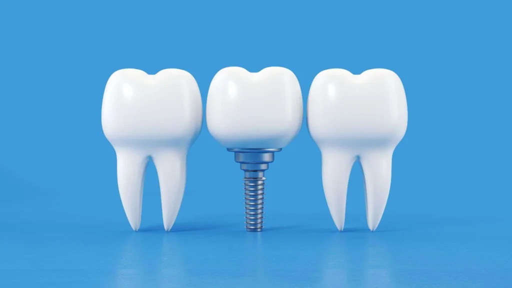 Learn to make your dental implant decision and know more