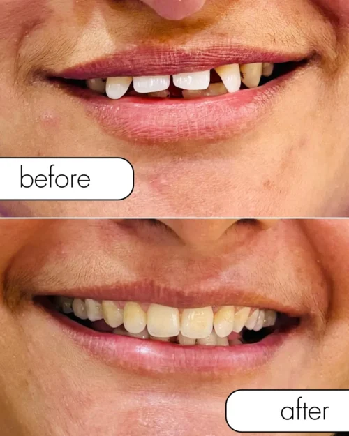 Aligners Before and After