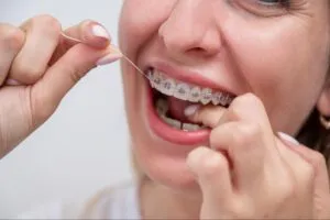 Braces & How to Take Care of Them